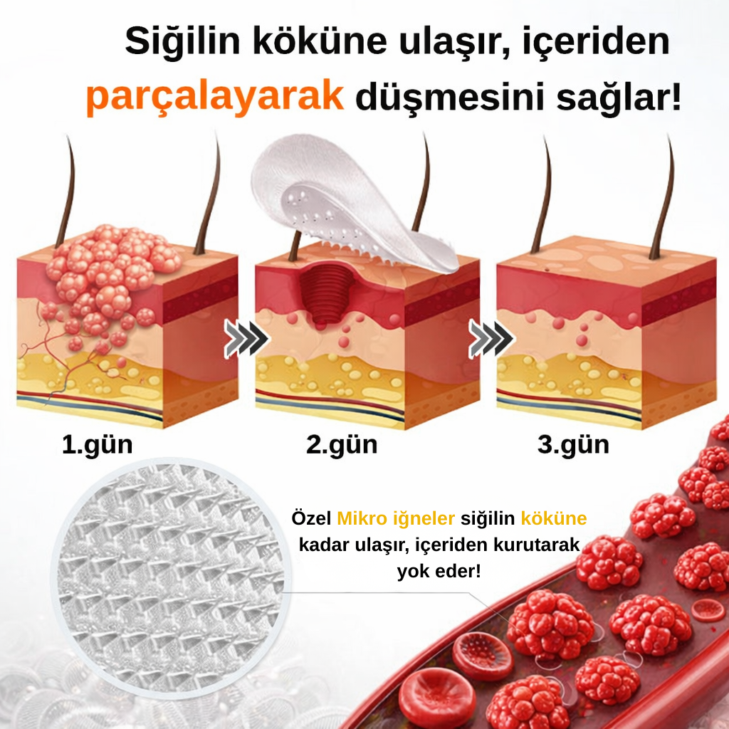 Ryles Mikro İğneli Siğil Bandı 5 Günde Acısız Son!